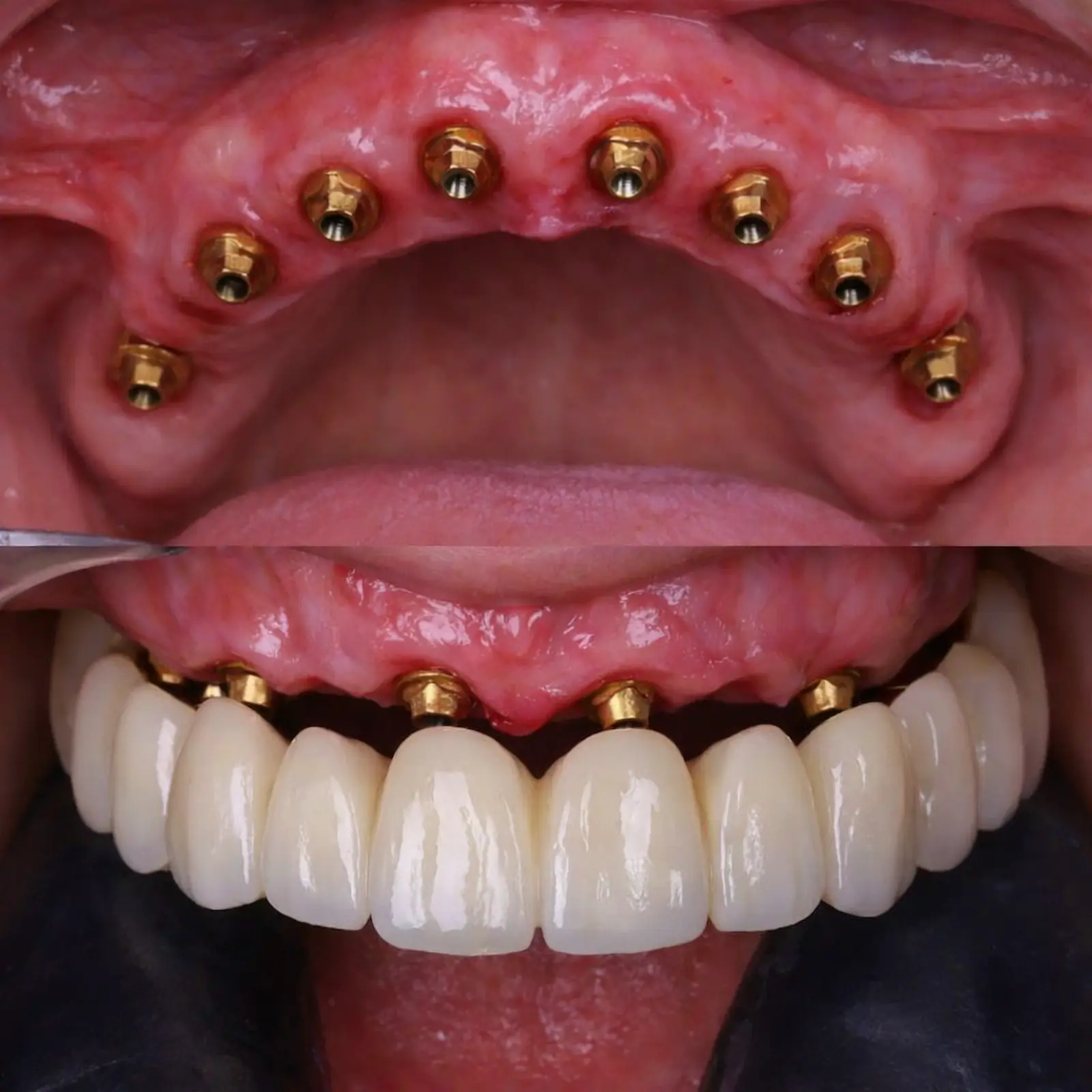 Implantes dentales en toda la boca con prótesis fija sobre implantes en Valencia