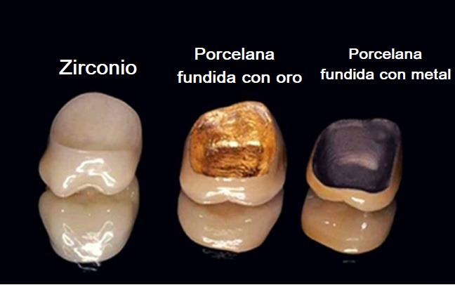 Comparación entre zirconio, porcelana fundida con oro y porcelana fundida con metal