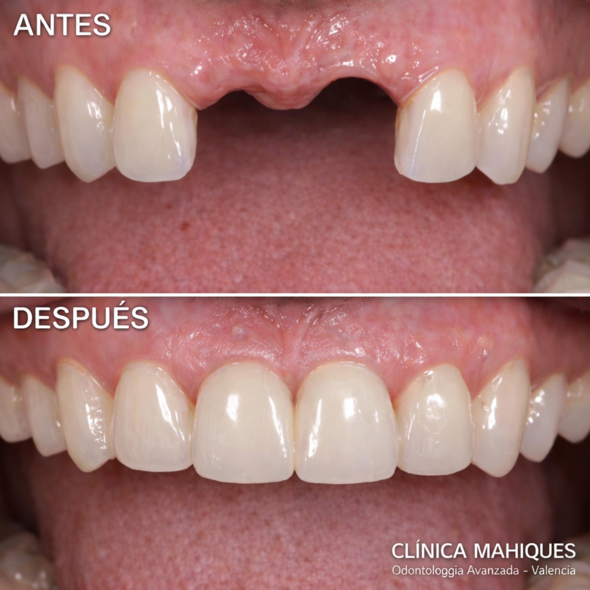 Antes y después de implante dental con corona de circonio en Valencia
