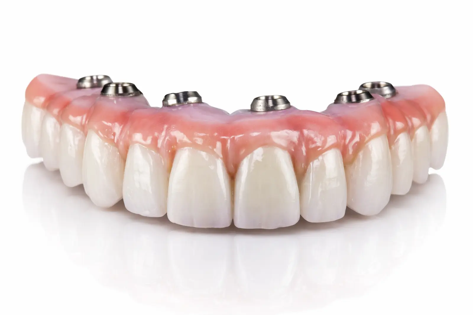 Prótesis completa fija sobre implantes dentales en Valencia