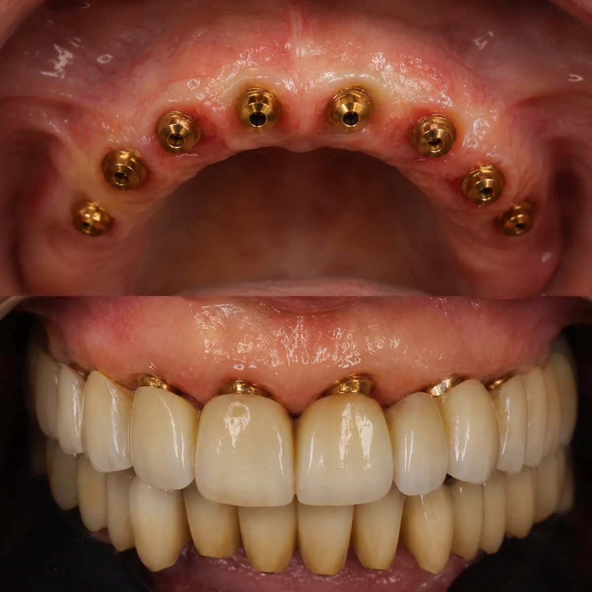 Implantes dentales en toda la boca con prótesis fija sobre implantes en Valencia